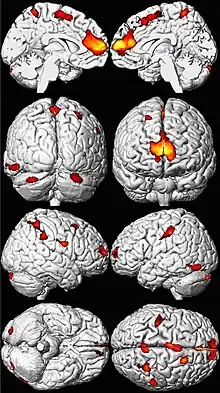 Eight MRI views of a brain in black and white, with yellow, orange, and red areas overlaid in spots mainly toward the front.