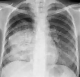 Dense homogenous opacity in right, middle and lower lobe of primary pulmonary TB.