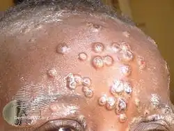 Mpox forehead