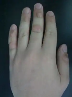 Compulsive picking of the knuckles (via mouth) illustrating potentially temporary disfiguration of the distal and proximal joints of the middle and little fingers