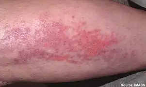 Forearm rash