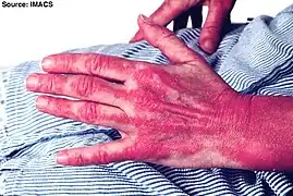 Severe rash on the hands, extending up the forearm