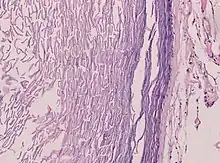 Histopathology showing epithelium and lamellated keratin (left)