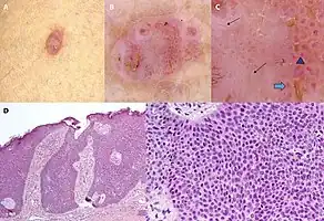 Dermoscopy and histopathology of eccrine poroma: (A) Clinical presentation of a nonpigmented eccrine poroma sensu stricto as a pink nodule located on the foot (B,C) Dermoscopy shows milky red areas (light blue arrow), milky red globules (dark blue triangle), and dotted vessels (black arrow) (original magnifications ×20 and ×40, respectively). (D,E) Histopathologically, the neoplasm consists of poroid and cuticular cells and tubular structures that are continuous with the epidermis (H&E stain, original magnifications ×10 and ×40, respectively).