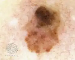 Dermoscopy of nodular melanoma arising within a superficial spreading melanoma