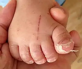 Skin peeling in hand foot and mouth disease