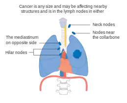 Stage IIIB lung cancer