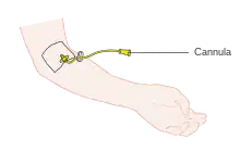 Diagram showing a cannula