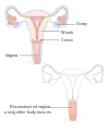 A radical hysterectomy for vaginal cancer with reconstruction of the vagina using other tissues