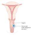 A local surgery to remove vaginal cancer