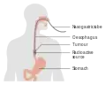 Internal radiotherapy for esophageal cancer