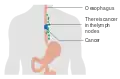 Esophageal cancer with spread to lymph nodes
