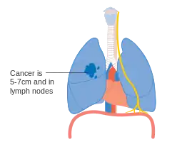 Stage IIB lung cancer