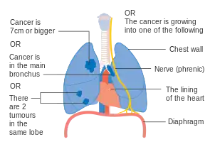 One option for stage IIB lung cancer, with T2b; but if tumor is within 2 cm of the carina, this is stage 3