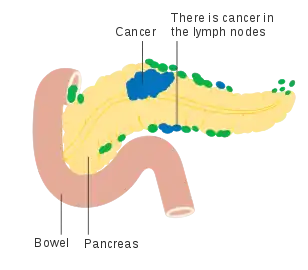 Pancreatic cancer in nearby lymph nodes – Stage N1