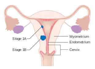 A diagram of stage IA and IB endometrial cancer
