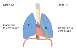 Stage IA and IB lung cancer