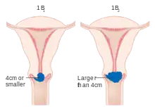 Stage 1B cervical cancer