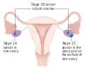 Stage 1 ovarian cancer