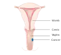 Stage 1 vaginal cancer