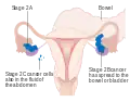Stage 2 ovarian cancer