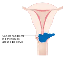 Stage 2B cervical cancer