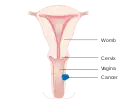 Stage 2 vaginal cancer