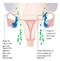 Stage 3 ovarian cancer