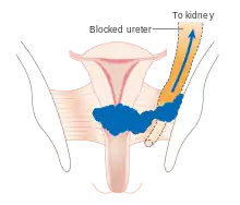 Stage 3B cervical cancer