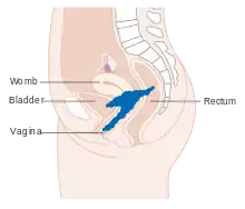 Stage 4A cervical cancer