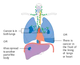 Stage IV lung cancer
