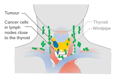 Stage N1a thyroid cancer