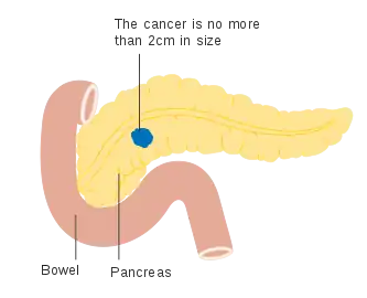 Stage T1 pancreatic cancer