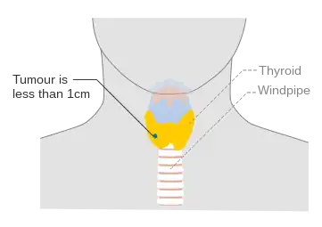 Stage T1a thyroid cancer