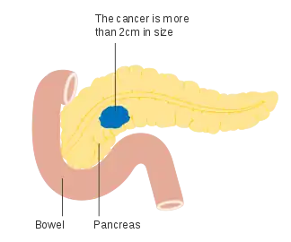Stage T2 pancreatic cancer