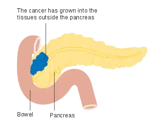 Stage T3 pancreatic cancer