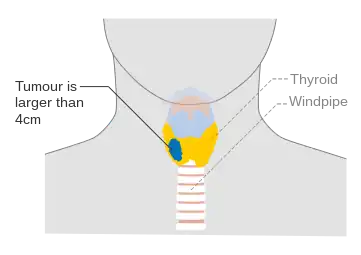 Stage T3 thyroid cancer