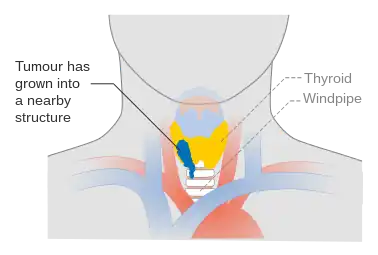 Stage T4a thyroid cancer