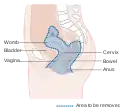 Diagram showing the area removed with a posterior surgery