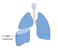 Removal of two lobes of the lung
