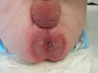 Severe diaper rash with ulceration