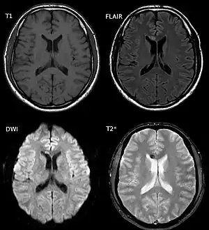 Diffuse axonal injury after a motorcycle accident. MRI after 3 days: on T1-weighted images the injury is barely visible. On the FLAIR, DWI and T2*-weighted images a small bleed is identifiable.