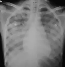 X-ray showing lungs bleeding due to leptospirosis infection