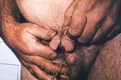 Man showing signs of hypospadias, including a bifid penis