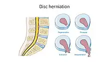 Illustration showing disc degeneration, prolapse, extrusion and sequestration.