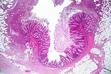 Diverticulitis showing acute purulent inflammation extending into the subserosal adipose tissue.
