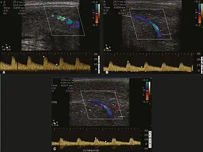 Longitudinal, ventral ultrasound of the penis, with pulsed mode and color Doppler. Flow of the cavernous arteries at 5, 15, and 25 min after prostaglandin injection (A, B, and C, respectively). The cavernous artery flow remains below the expected levels (at least 25–35 cm/s), which indicates ED due to arterial insufficiency.