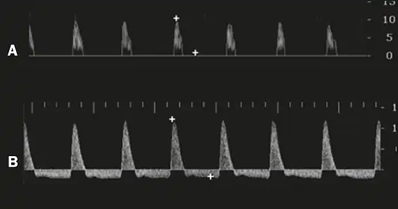 Graphs representing the color Doppler spectrum of the flow pattern of the cavernous arteries during the erection phases. A: Single-phase flow with minimal or absent diastole when the penis is flaccid. B: Increased systolic flow and reverse diastole 25 min after injection of prostaglandin.