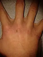 Effects of xeroderma on the hand