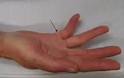 Dupuytren's contracture of the right little finger. Arrow marks the area of scarring